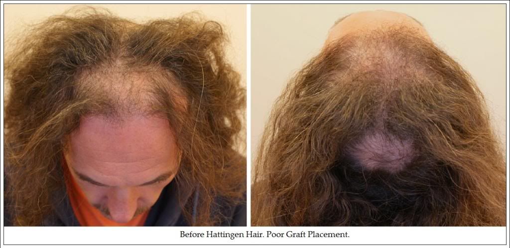 International Hair Loss Forum - Hattingen HT (Suisse International Hair Loss Forum - Hattingen HT (Suisse